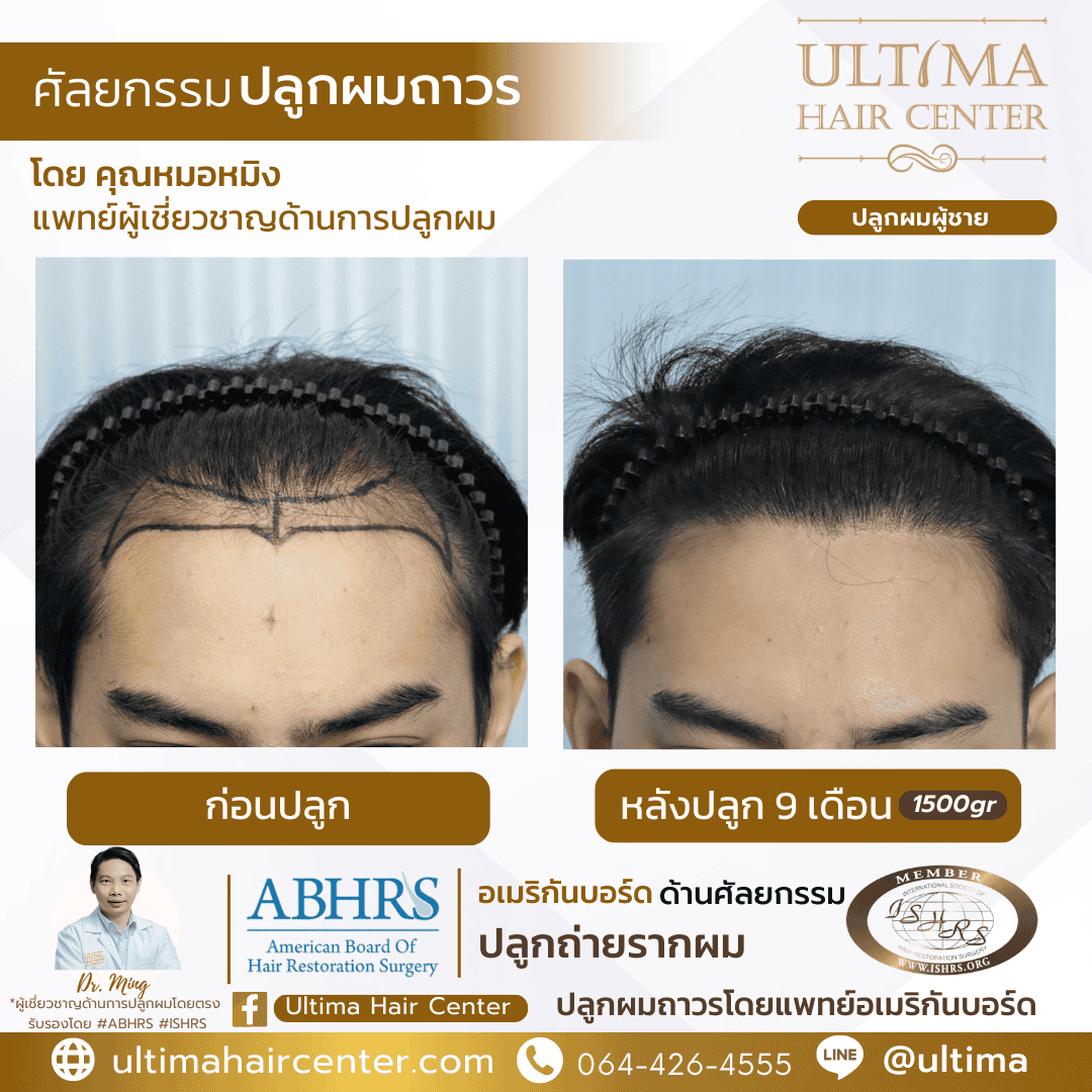 การเตรียมตัวก่อนปลูกผม FUE