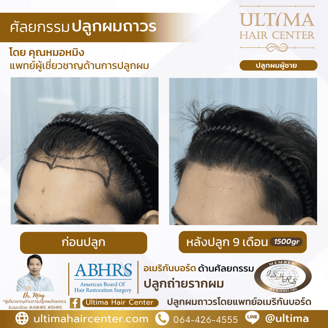 ปลูกผม FUE ราคาเท่าไร 