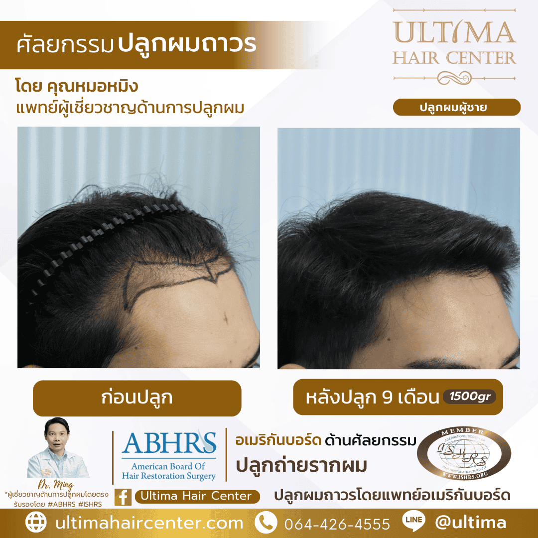 ปลูกผม FUE ราคาเท่าไร 