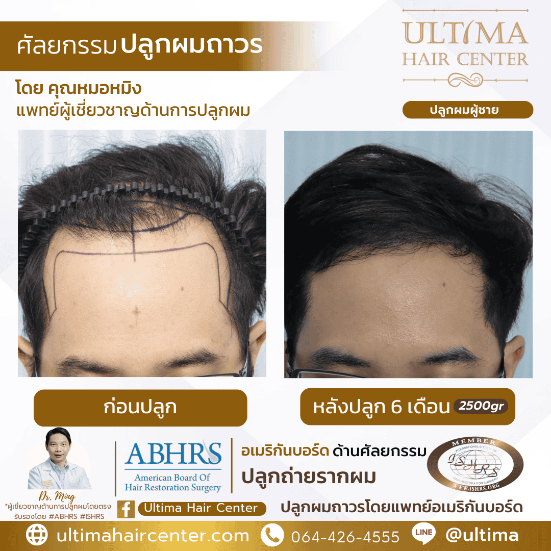 ปลูกผม FUE ราคาเท่าไร 