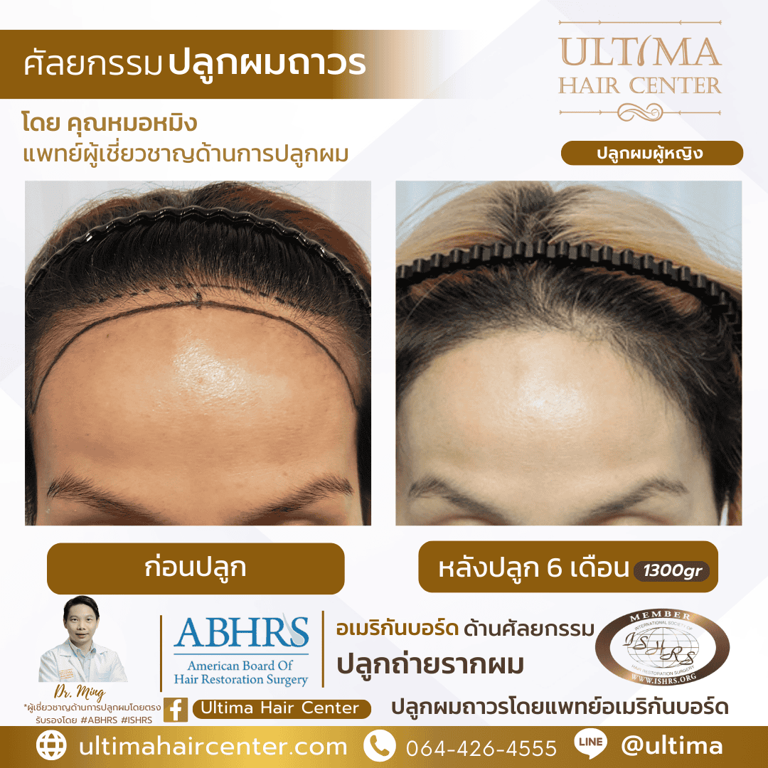 ปลูกผมผู้หญิง จะเห็นผลลัพธ์เมื่อใด