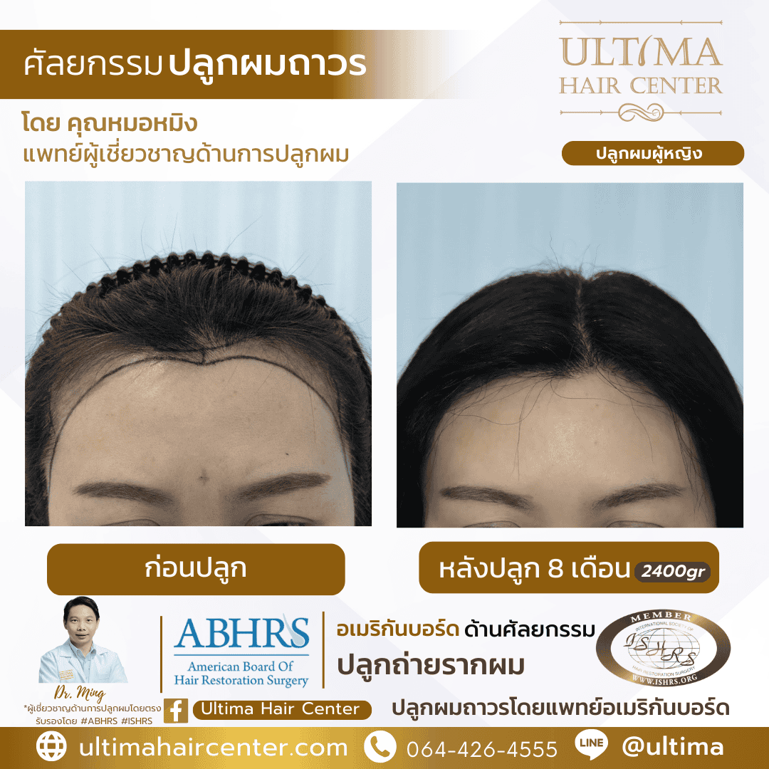 รีวิวปลูกผม หลังปลูก 9-12 เดือน