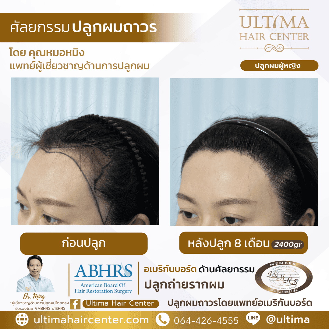 ปลูกผมผู้หญิง เทคนิค FUE คืออะไร
