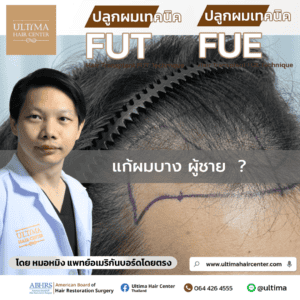 แก้ผมบาง ผู้ชาย