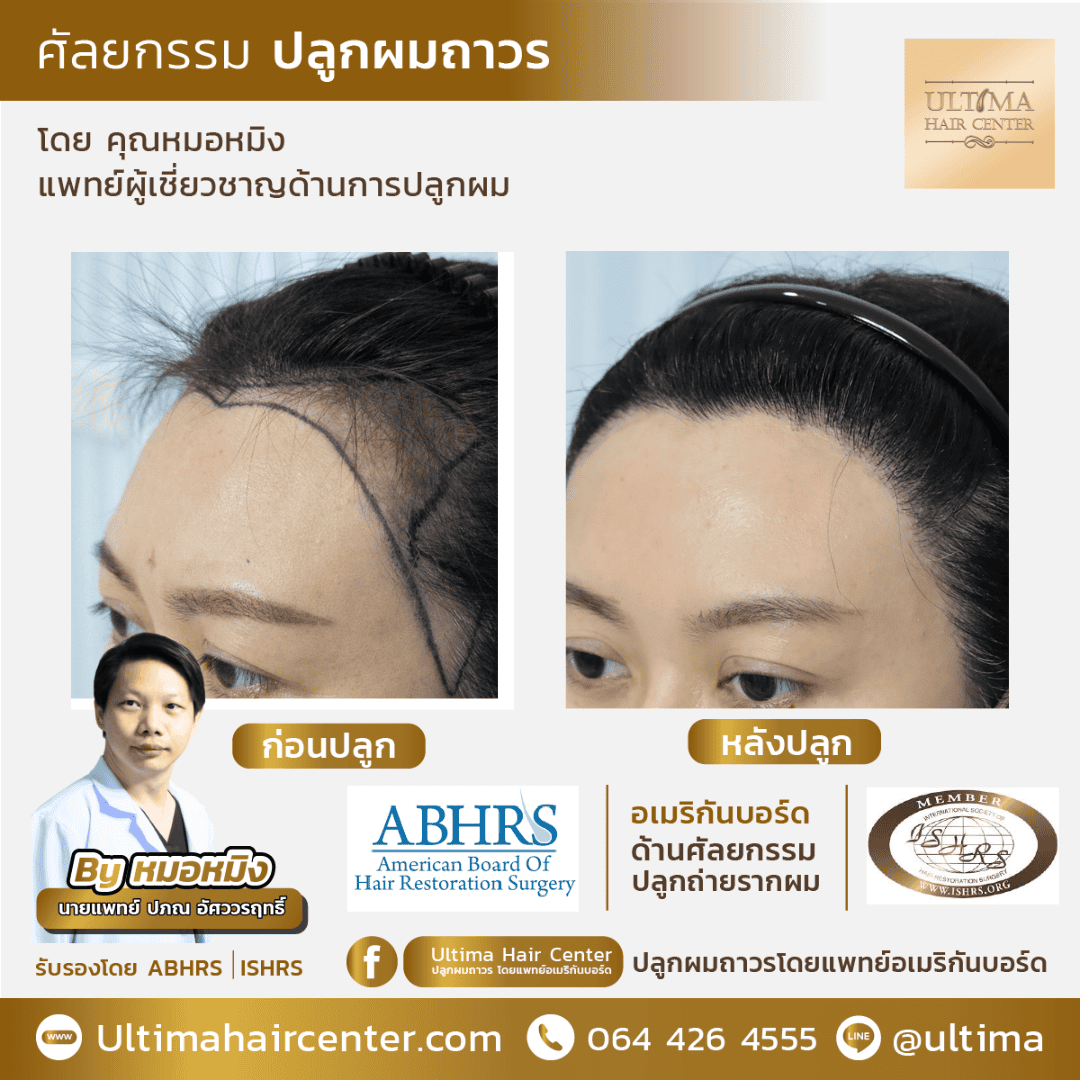 ปลูกผมขึ้นจริงไหม