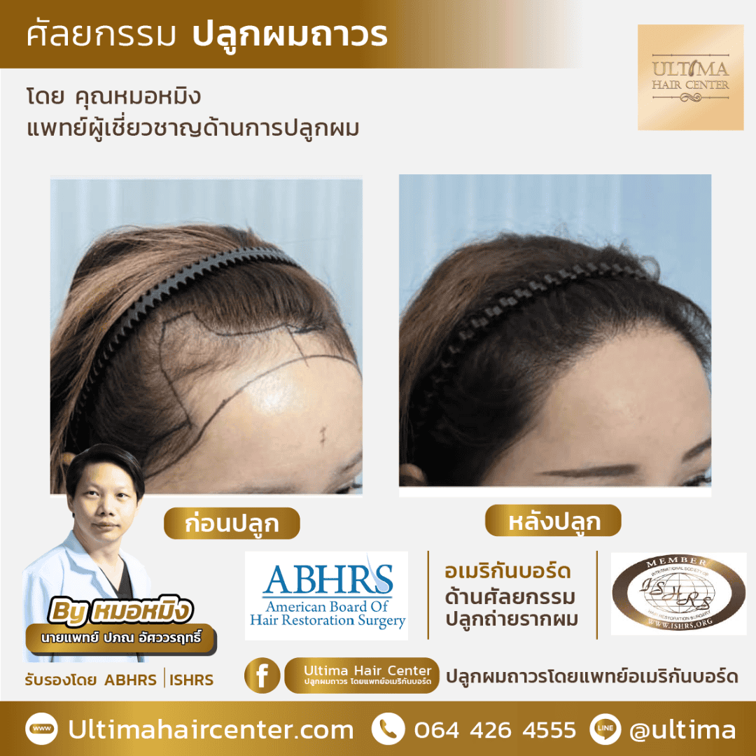 ปลูกผมที่ไหนดี 2567