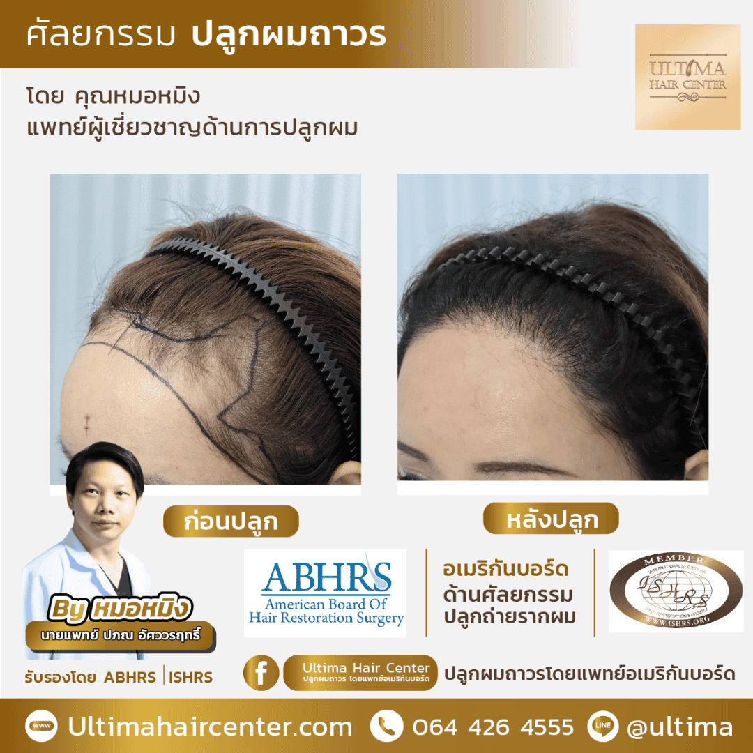 ปลูกผมที่ไหนดี 2567