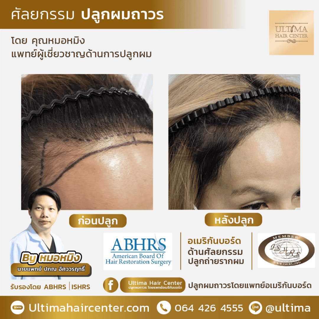 ปลูกผมที่ไหนดี 2567