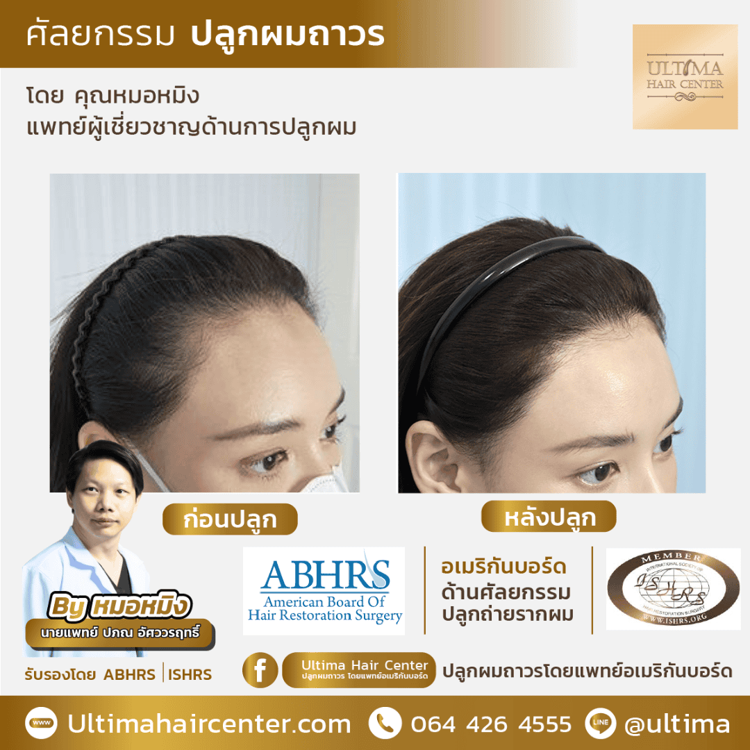 ปลูกผมที่ไหนดี 2567