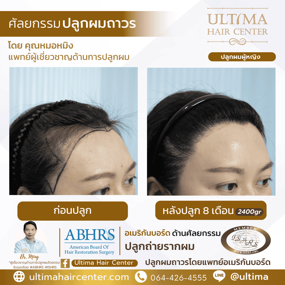 ปลูกผมผู้หญิง เทคนิค FUE คืออะไร