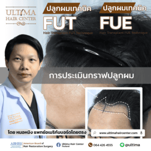 การประเมินกราฟปลูกผม
