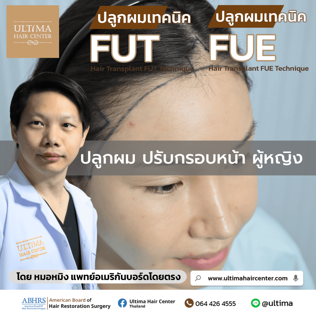 ปลูกผม ปรับกรอบหน้า ผู้หญิง