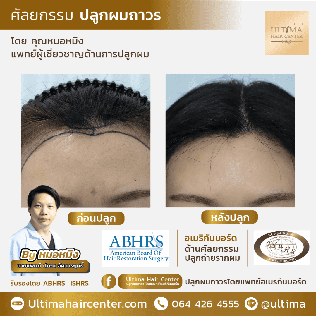 ปลูกผม ปรับกรอบหน้า ผู้หญิง