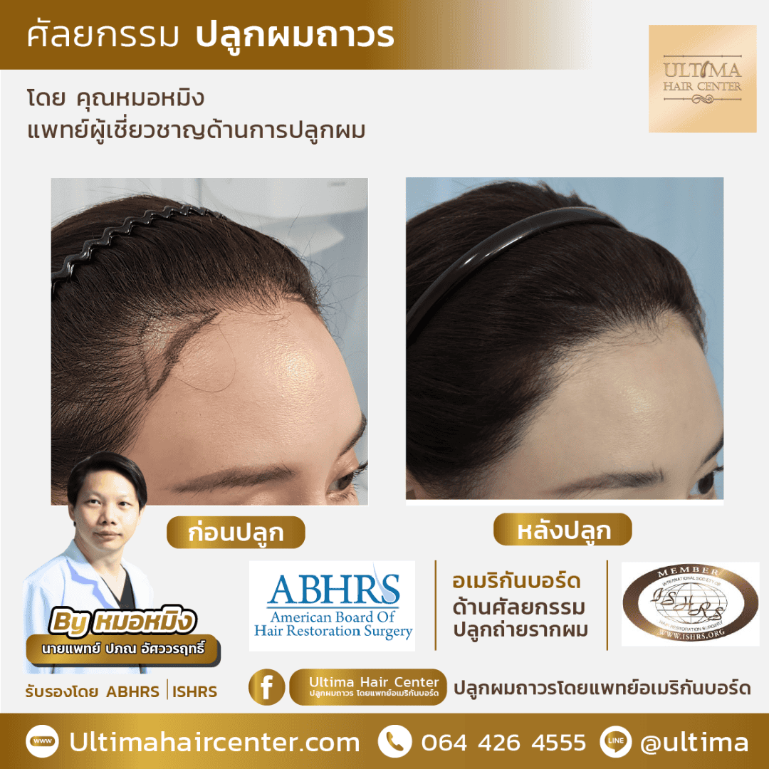 ปลูกผม ปรับกรอบหน้า