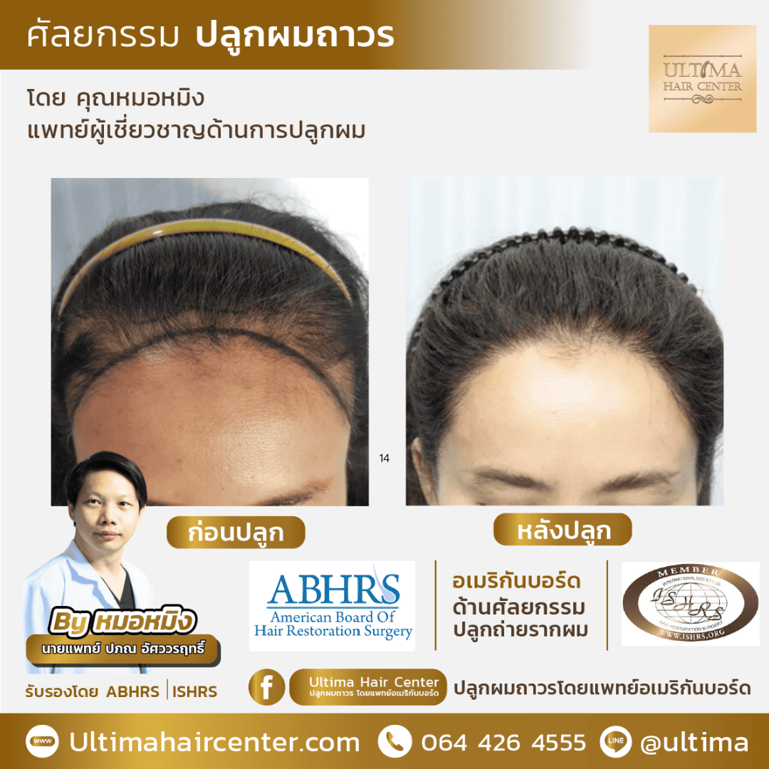 ปลูกผม ปรับกรอบหน้า