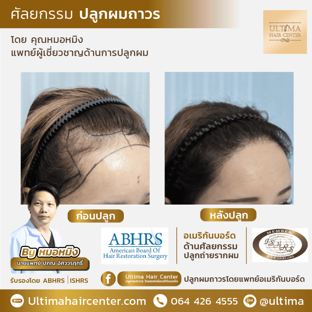 ปลูกผม ปรับกรอบหน้า