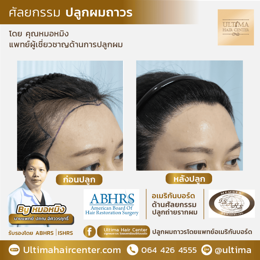 ปลูกผม ปรับกรอบหน้า ผู้หญิง