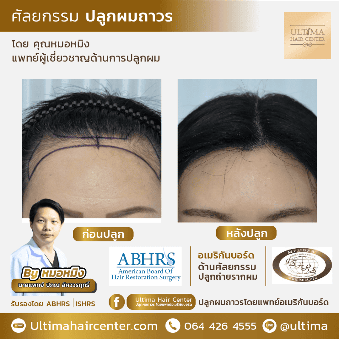 ปลูกผม ปรับกรอบหน้า ผู้หญิง