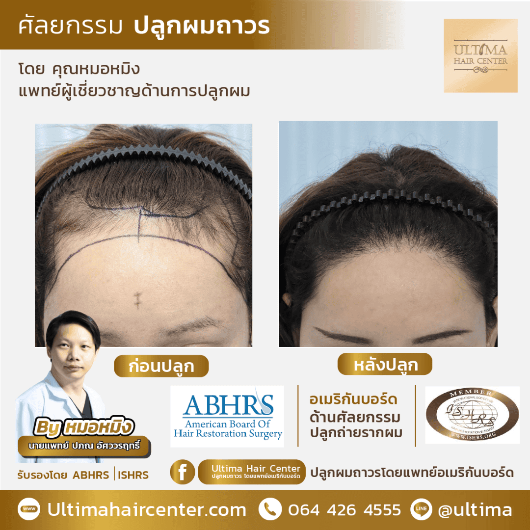 ปลูกผม ปรับกรอบหน้า ผู้หญิง