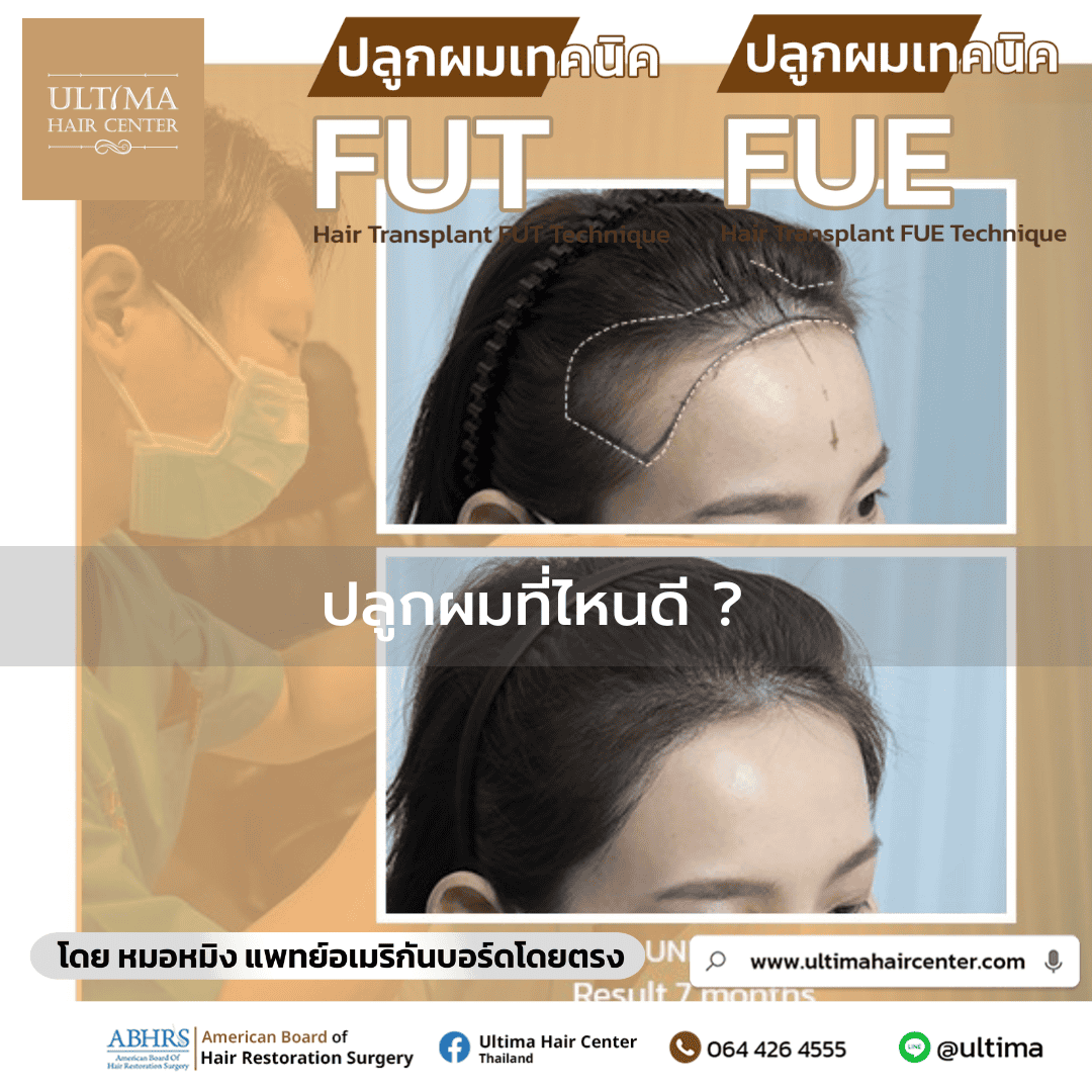 ปลูกผมที่ไหนดี 