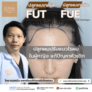 ปลูกผมปรับแนวไรผม ในผู้หญิง แก้ปัญหาหัวเถิก