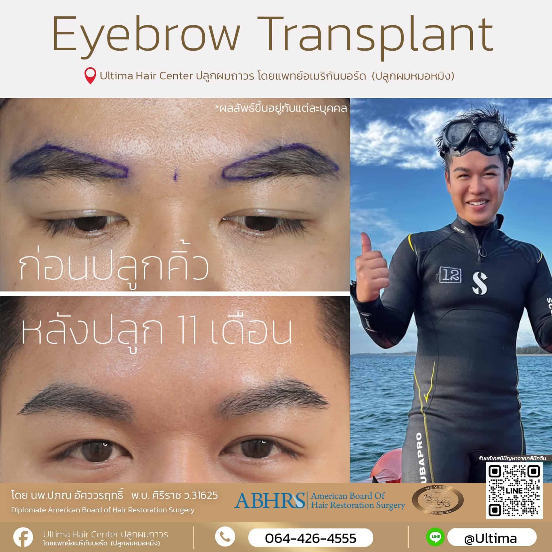 ปลูกคิ้วถาวร
