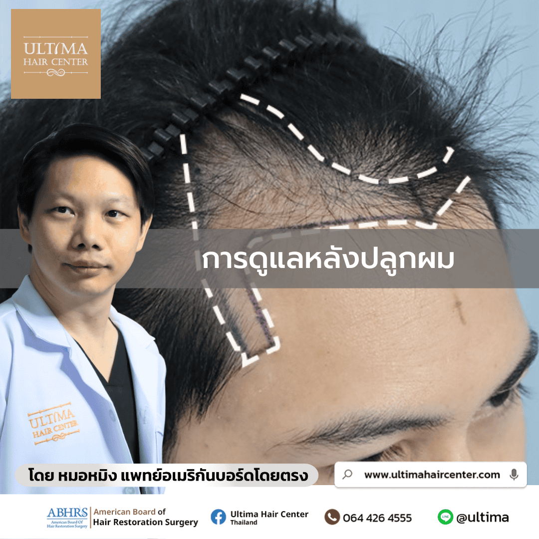 การดูแลหลังปลูกผม