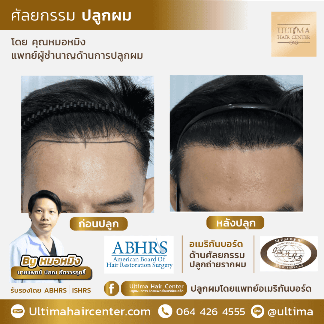 ปลูกผมผู้หญิง Female Transplant คืออะไร