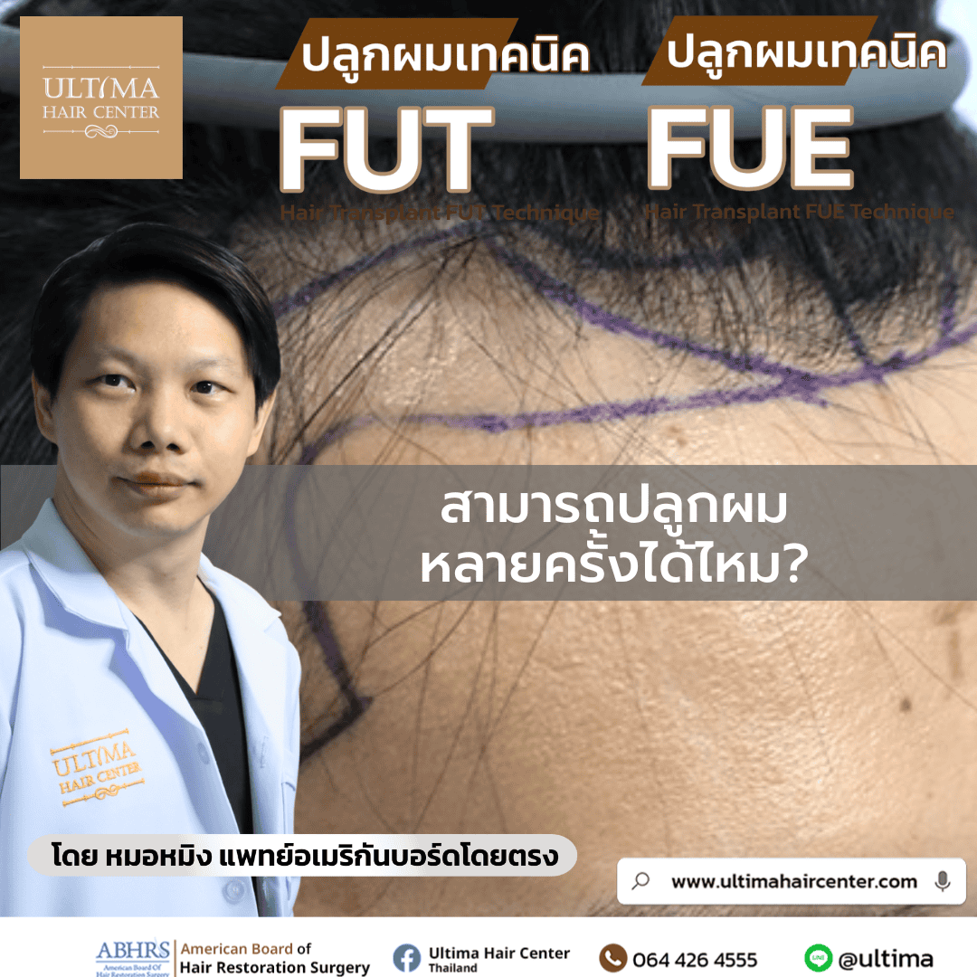 สามารถปลูกผมหลายครั้งได้ไหม