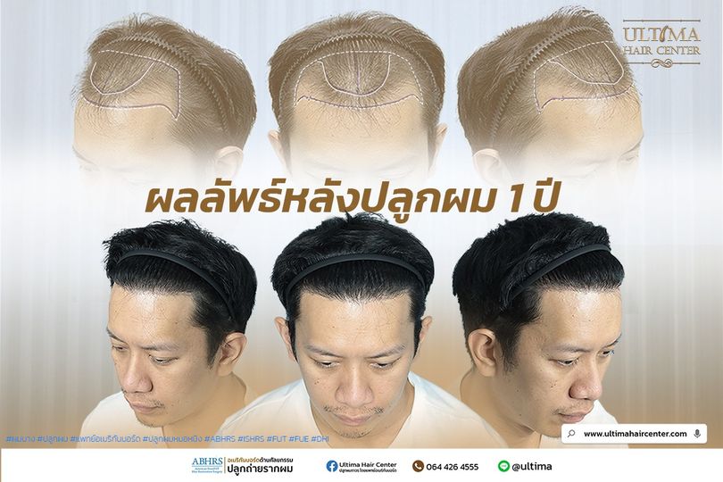 รีวิวปลูกผมผู้ชายใน Pantip น่าเชื่อถือจริงไหม