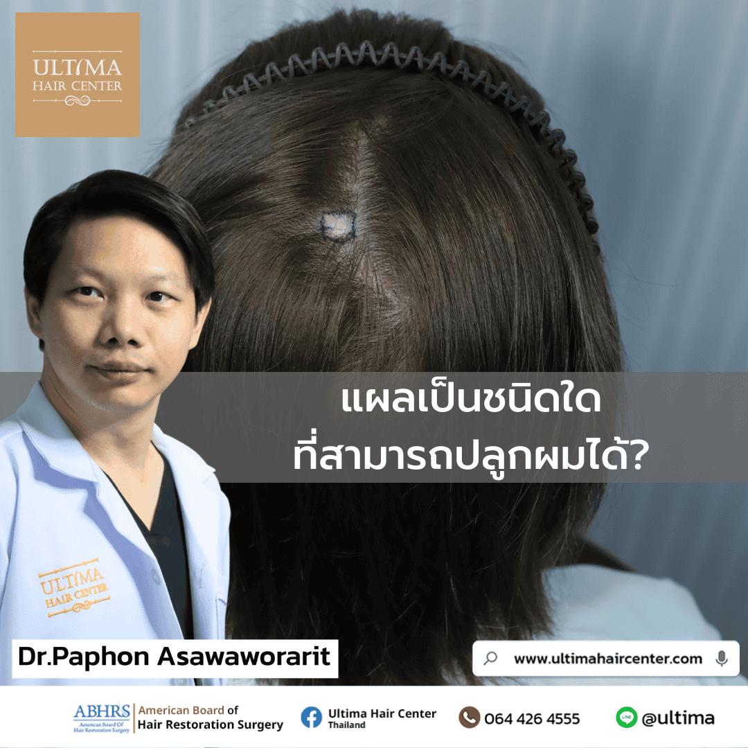 ปลูกผมทับแผลเป็น ใช้เวลานานแค่ไหน