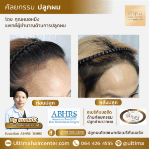 ปลูกผม ผู้หญิง