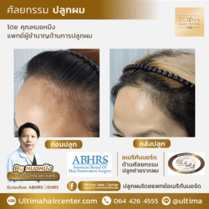 ปลูกผม ผู้หญิง