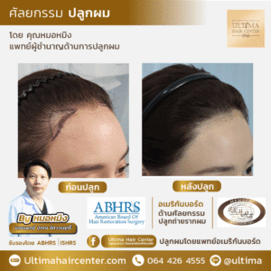 ปลูกผม ผู้หญิง