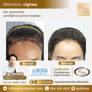 ปลูกผม ผู้หญิง