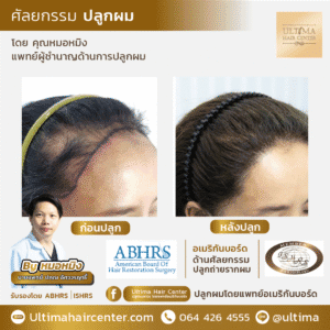 ปลูกผม ผู้หญิง