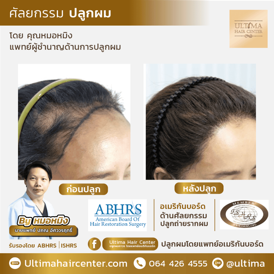 ทำไมการปลูกผมกับแพทย์ที่ได้รับการรับรองจาก ABHRS จึงสำคัญต่อผลลัพธ์