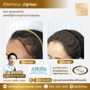 ปลูกผม ผู้หญิง