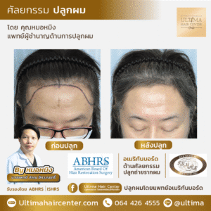 ปลูกผม ผู้หญิง