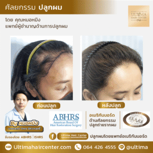 ปลูกผม ผู้หญิง