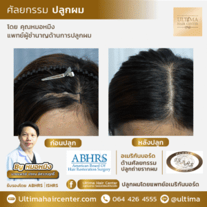 ปลูกผมทับแผลเป็น ผมจะร่วงอีกหรือไม่