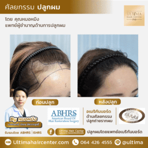 ปลูกผม ผู้หญิง