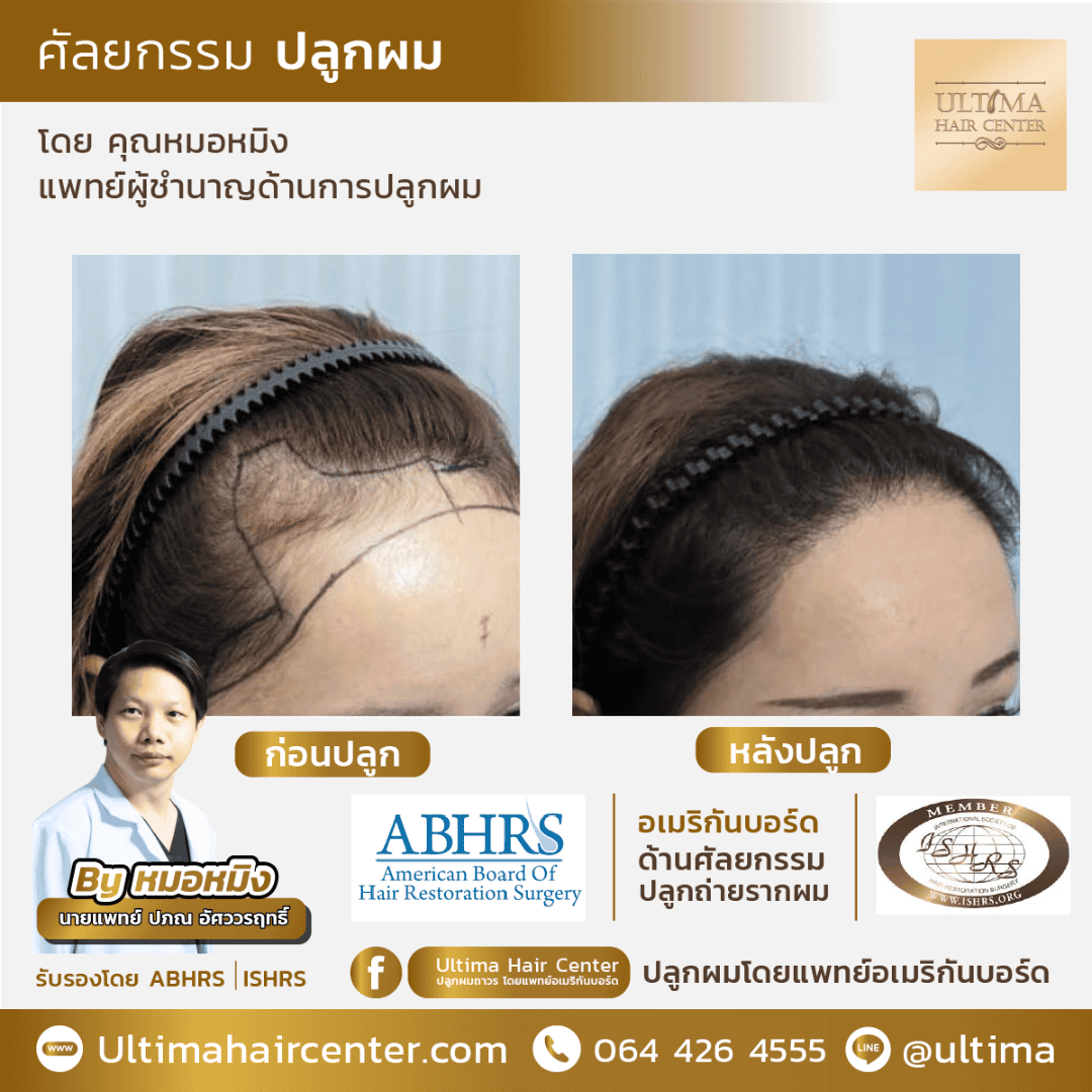 ทำไมการปลูกผมกับแพทย์ที่ได้รับการรับรองจาก ABHRS จึงสำคัญต่อผลลัพธ์