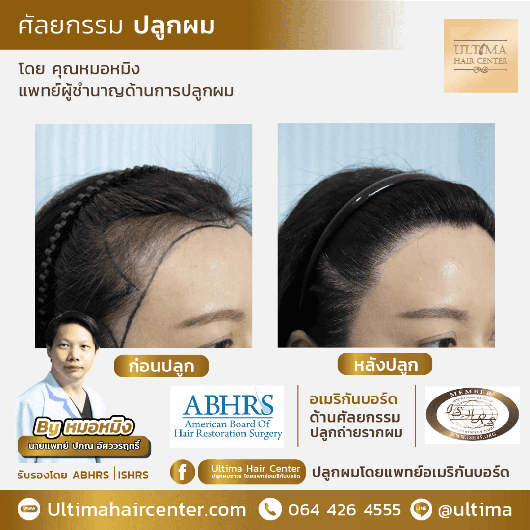 ผู้หญิงผมบางตรงรอยแสก รักษาแบบไหนได้บ้าง