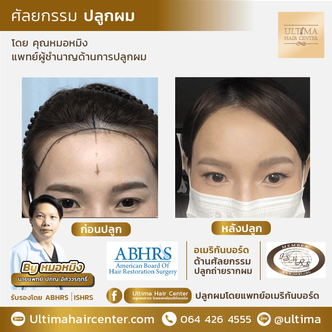 ผู้หญิงผมบางตรงรอยแสก รักษาแบบไหนได้บ้าง