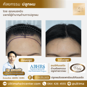 หลังปลูกผม ควรนอนอย่างไร