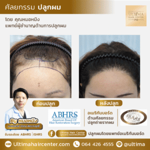 ปลูกผม ผู้หญิง