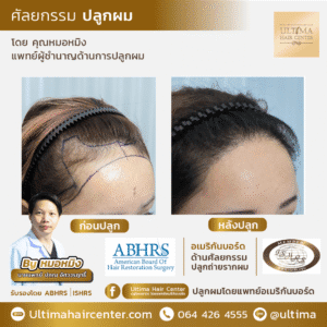 ปลูกผม ผู้หญิง