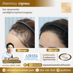 ปลูกผม ผู้หญิง