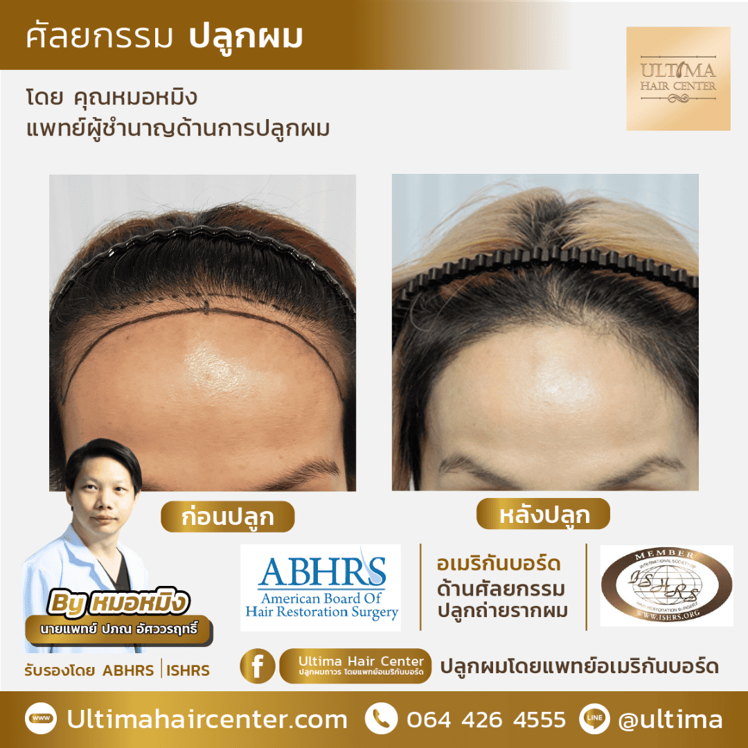 ผู้หญิงผมบางตรงรอยแสก รักษาแบบไหนได้บ้าง